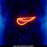 Why Is Pancreatic Cancer So Under-Diagnosed?