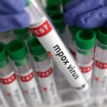 Bengaluru Reports 1st Mpox Case Of 2025 In 40-Year-Old Man With Travel History