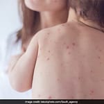 Measles Outbreak In Texas: What We Know So Far