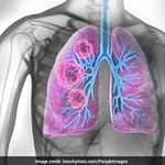 Lung Cancer Cases Rising In Non-Smoking Women: Risk Factors & Causes