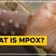 thumb2520mpox